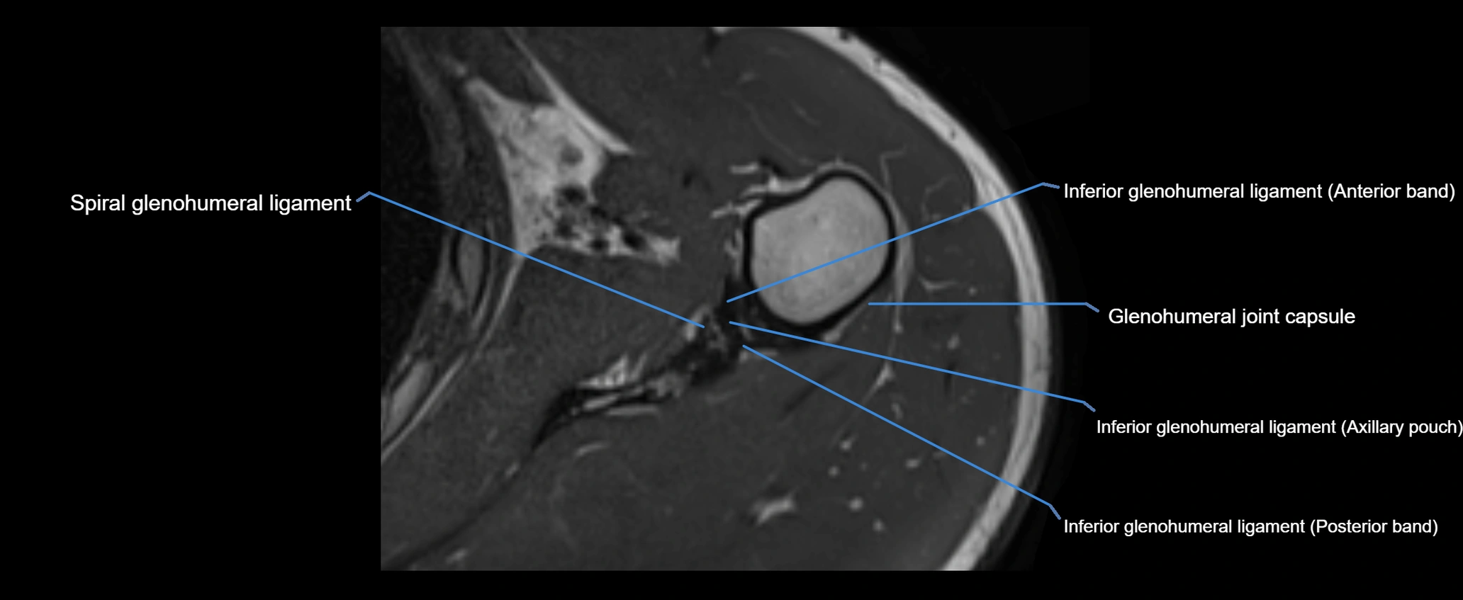 shoulder ligaments axial 3d 3t mri image-img-00005-00087.webp